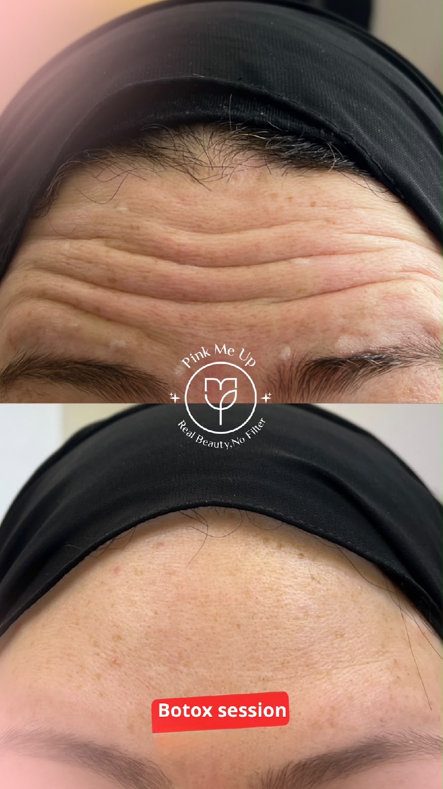10 mins can remove years of wrinckles